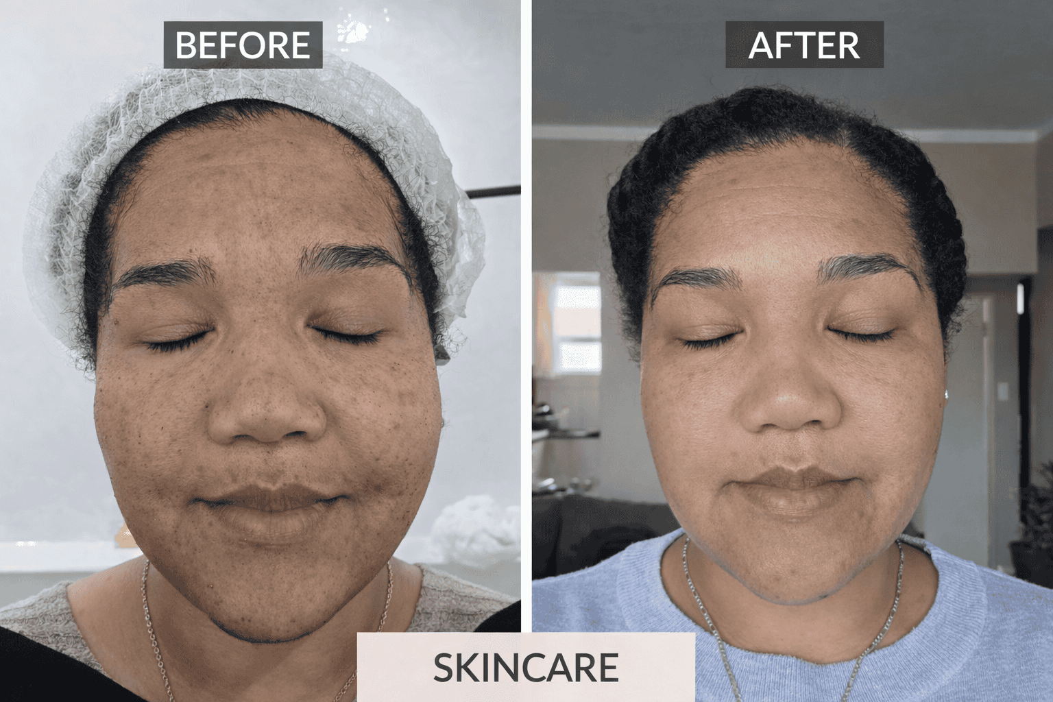 Before and after algae peel