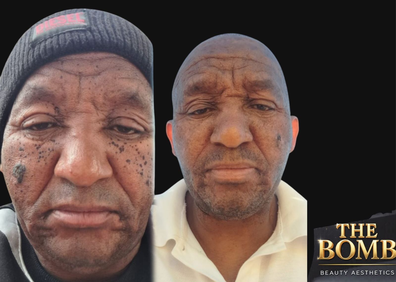 Skin tag removal procedure