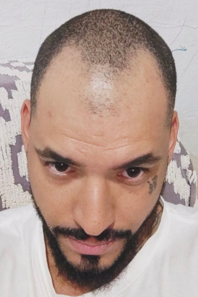 Before scalp micropigmentation
