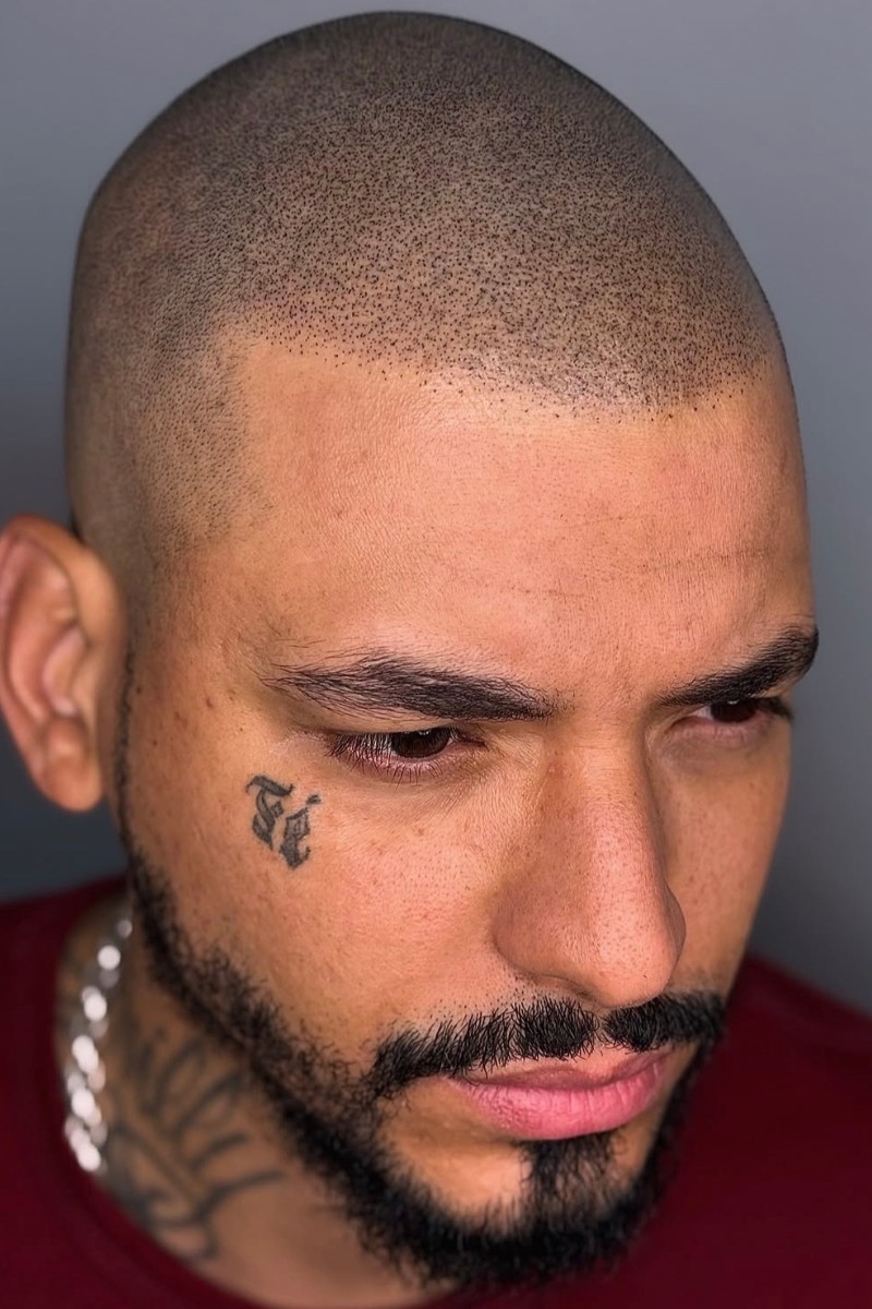 After scalp micropigmentation