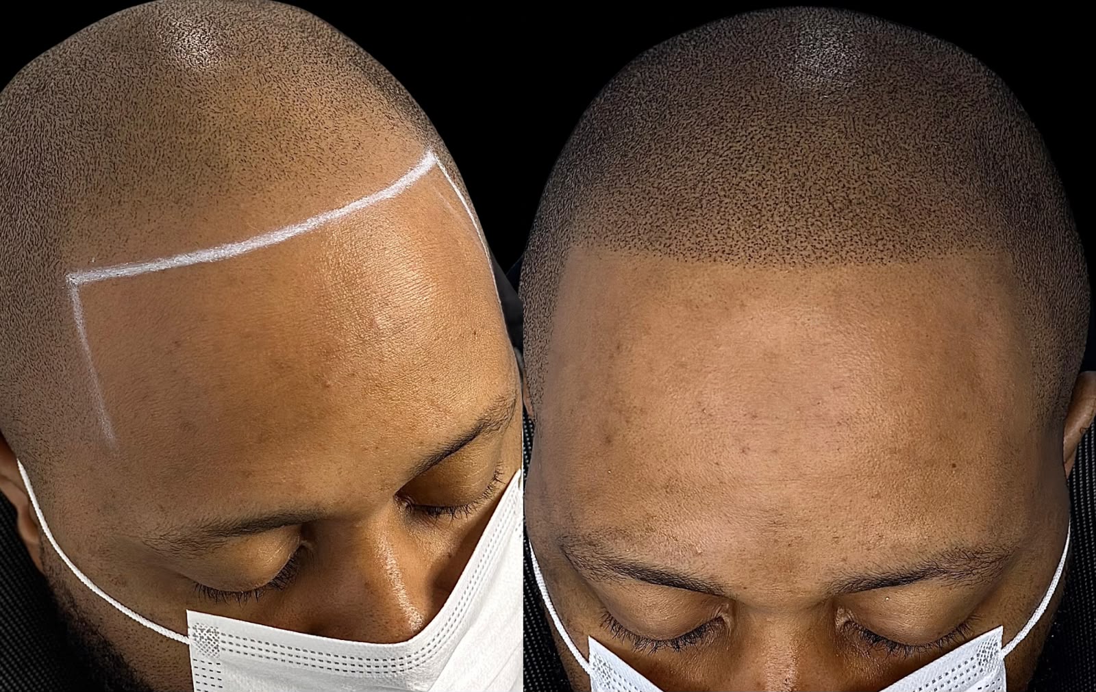 Scalp micropigmentation treatment