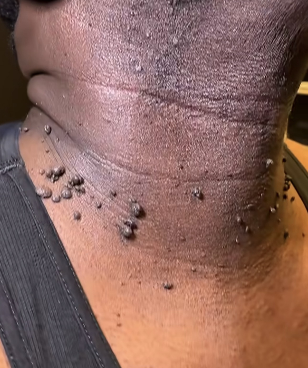 Before skin tag removal