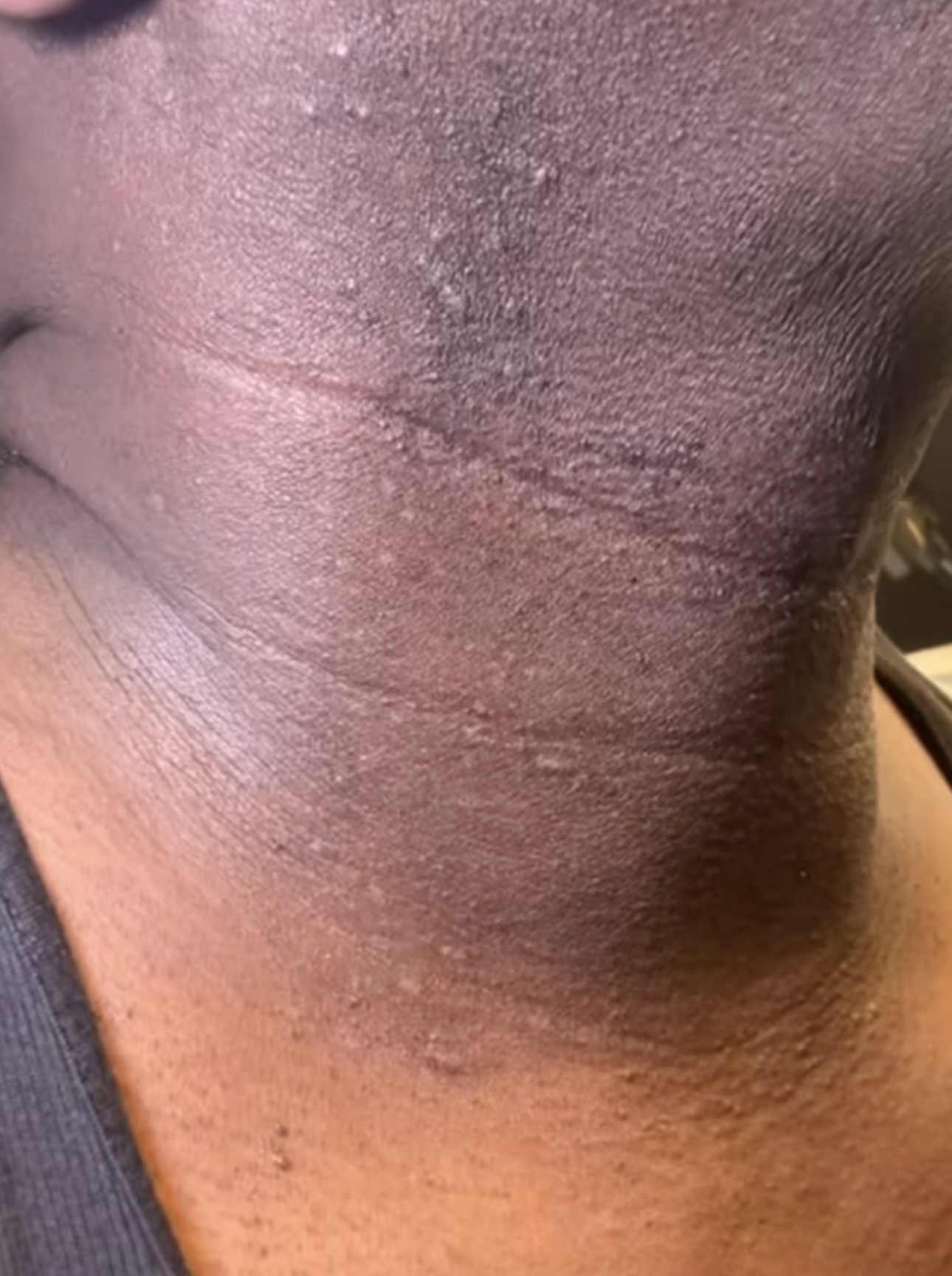 After skin tag removal